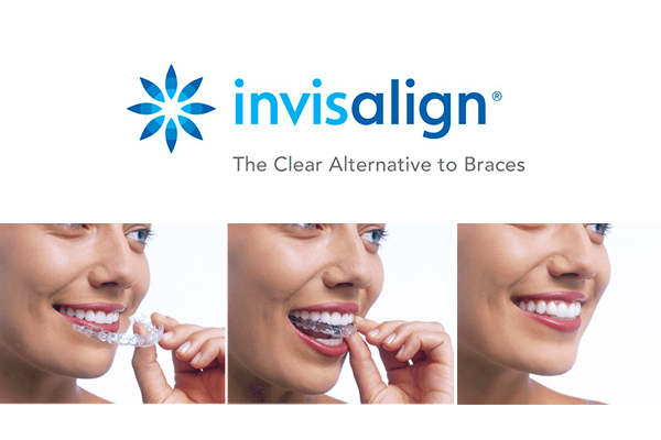 Invisalign en Tijuana
