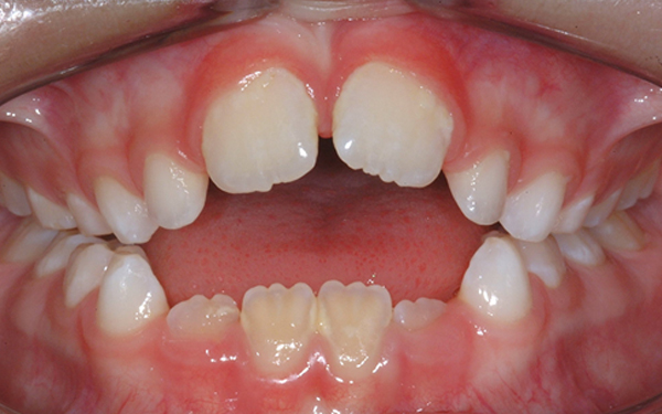 tratamiento-temprano-succion-digital-ortodoncia-infantil-dentadura